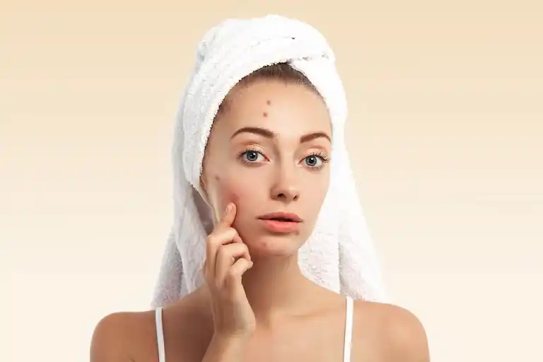 Calamine Lotion for Makeup and its Benefits for Acne-Tastefullspace