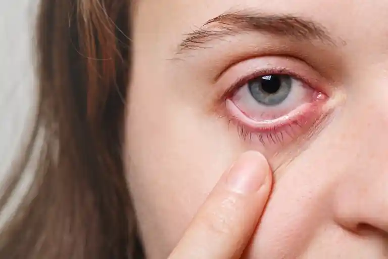 Skin Irritation Dry Eyes After Shower-Tastefullspace